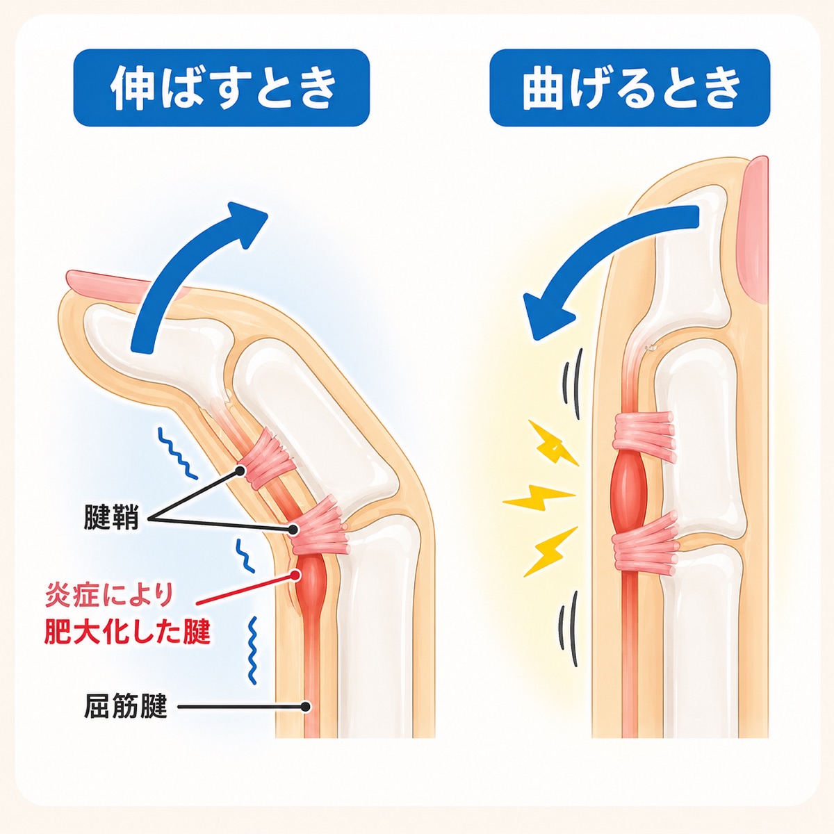 ばね指のメカニズム解説イラスト（伸ばすときと曲げるとき、腱鞘・肥大化した腱・屈筋腱）