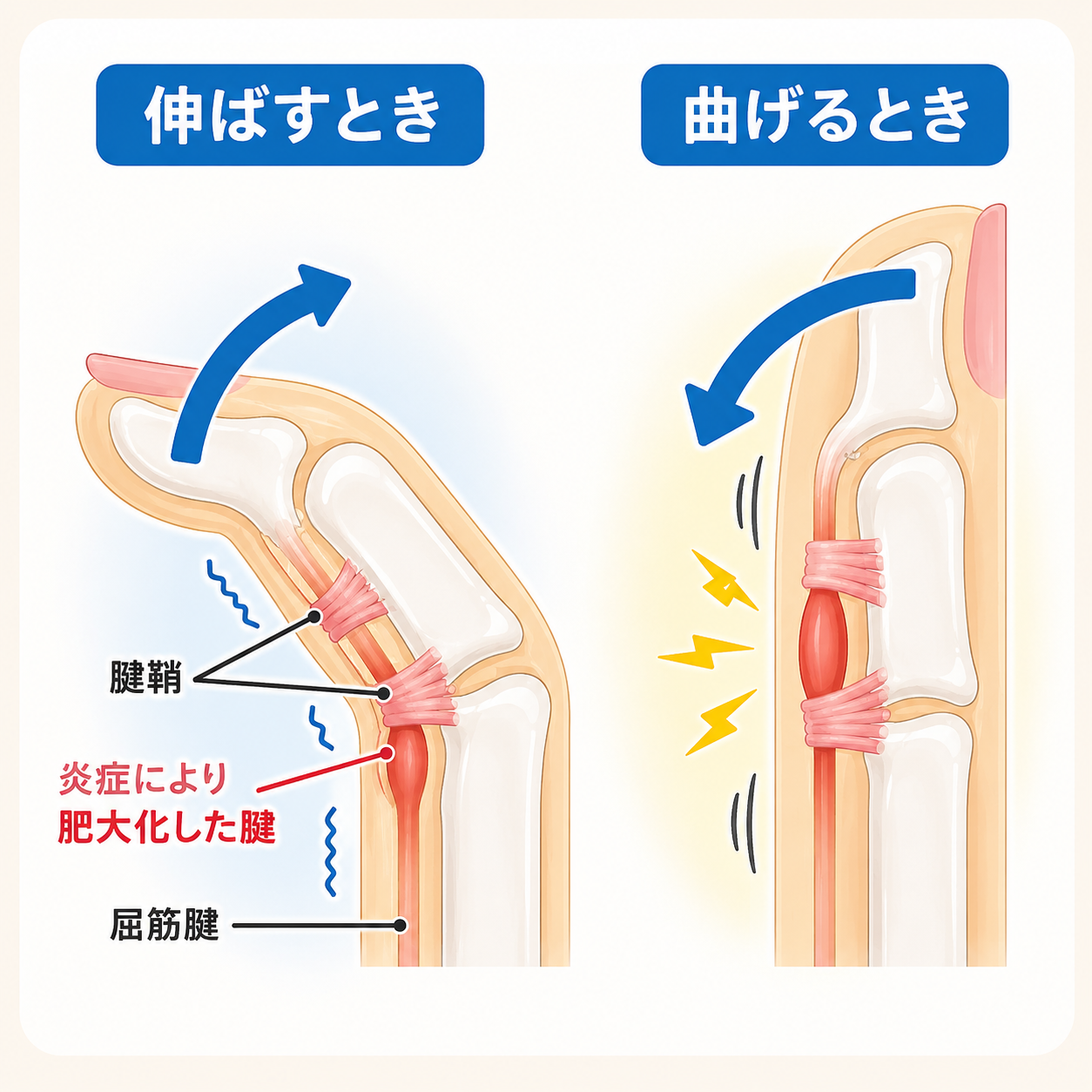 ばね指のメカニズム解説イラスト（伸ばすときと曲げるとき、腱鞘・肥大化した腱・屈筋腱）