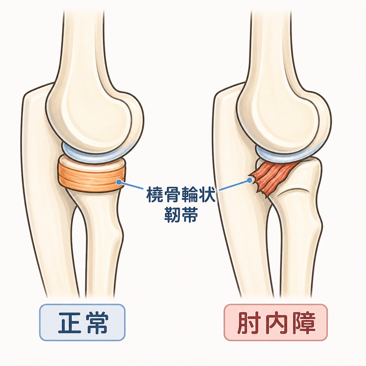正常な肘と、肘内障（亜脱臼）の比較イラスト